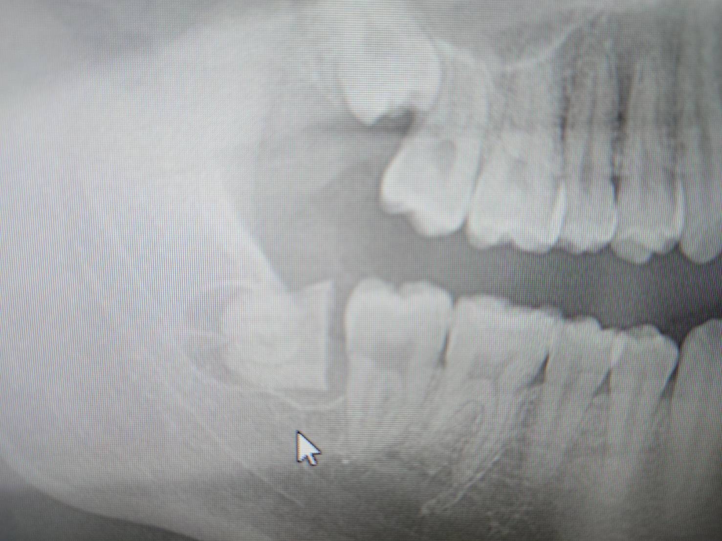親知らず抜歯